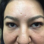 Facelift Before & After Patient #5052