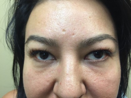 Facelift Before & After Patient #5052