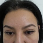Facelift Before & After Patient #5052