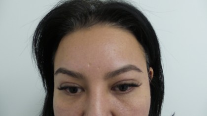 Facelift Before & After Patient #5052