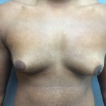 Gynecomastia Before & After Patient #5044
