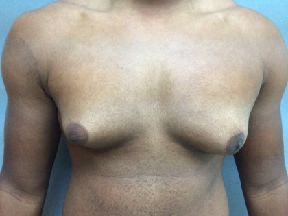 Gynecomastia Before & After Patient #5044