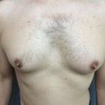 Gynecomastia Before & After Patient #5047