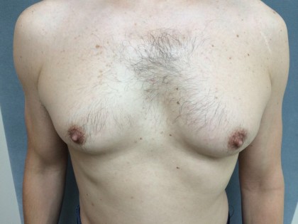 Gynecomastia Before & After Patient #5047