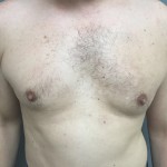 Gynecomastia Before & After Patient #5047
