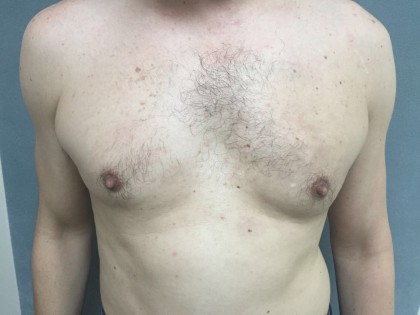 Gynecomastia Before & After Patient #5047