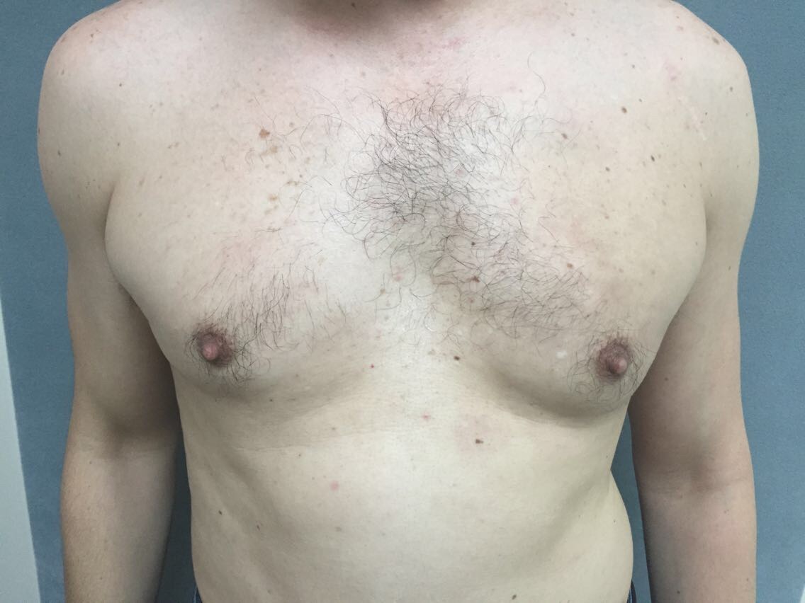 Gynecomastia Before & After Patient #5047
