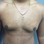 Gynecomastia Before & After Patient #5044