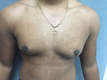 Gynecomastia Before & After Patient #5044