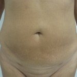 Liposuction Before & After Patient #5055
