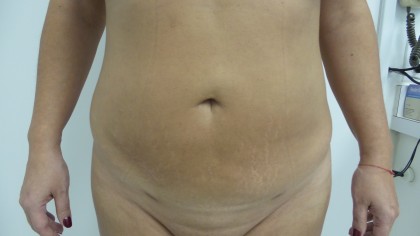 Liposuction Before & After Patient #5055