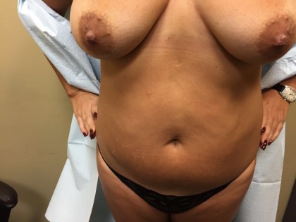 Liposuction Before & After Patient #5055