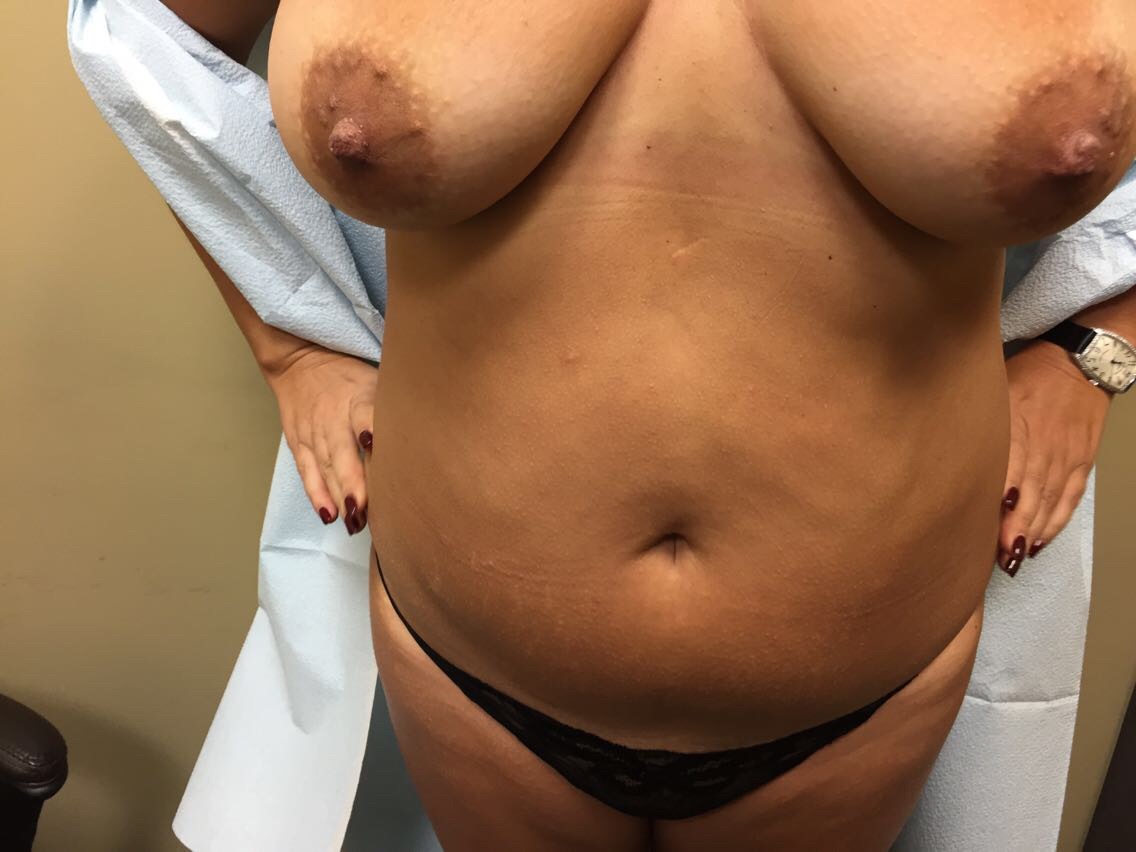 Liposuction Before & After Patient #5055