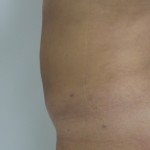 Liposuction Before & After Patient #5055