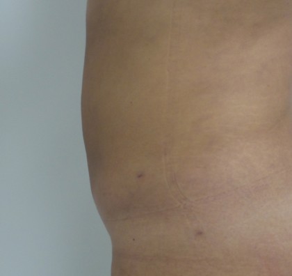 Liposuction Before & After Patient #5055