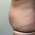 Liposuction Before & After Patient #5055