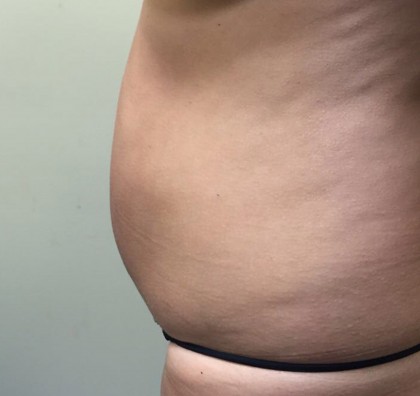 Liposuction Before & After Patient #5055