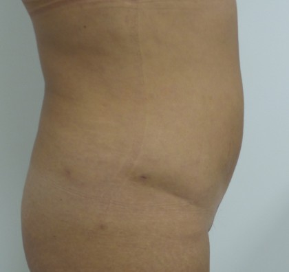 Liposuction Before & After Patient #5055