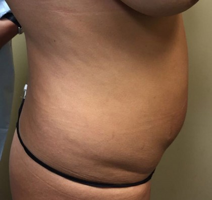 Liposuction Before & After Patient #5055