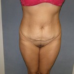 Tummy Tuck Before & After Patient #5037
