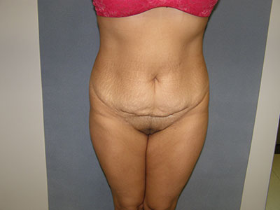 Tummy Tuck Before & After Patient #5037