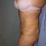 Tummy Tuck Before & After Patient #5037