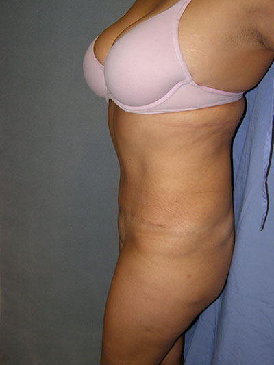 Tummy Tuck Before & After Patient #5037