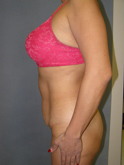 Tummy Tuck Before & After Patient #5037