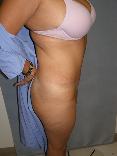 Tummy Tuck Before & After Patient #5037