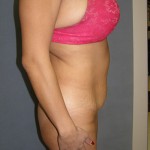 Tummy Tuck Before & After Patient #5037