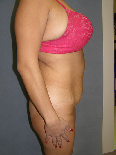 Tummy Tuck Before & After Patient #5037