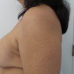 Breast Augmentation Before & After Patient #5074