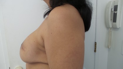 Breast Augmentation Before & After Patient #5074