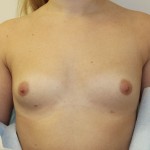 Breast Augmentation Before & After Patient #5069