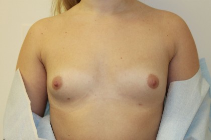 Breast Augmentation Before & After Patient #5069