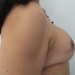 Breast Augmentation Before & After Patient #5074