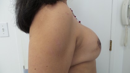 Breast Augmentation Before & After Patient #5074