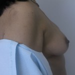 Breast Augmentation Before & After Patient #5074