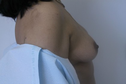 Breast Augmentation Before & After Patient #5074