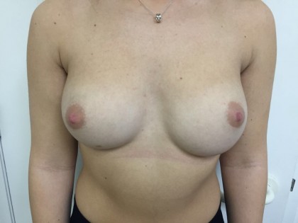 Breast Augmentation Before & After Patient #5069