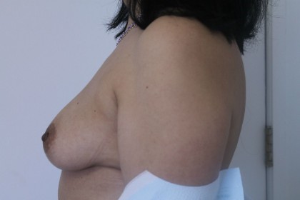 Breast Augmentation Before & After Patient #5074