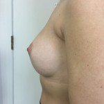 Breast Augmentation Before & After Patient #5069