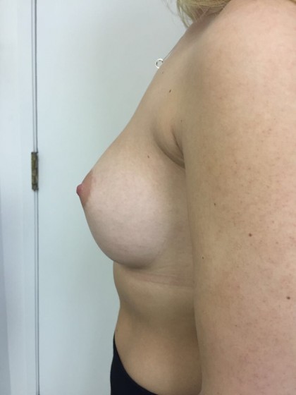 Breast Augmentation Before & After Patient #5069