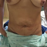 Tummy Tuck Before & After Patient #5082