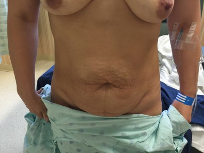 Tummy Tuck Before & After Patient #5082