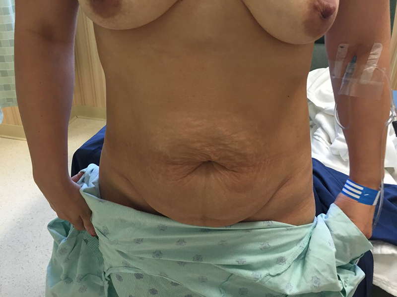 Tummy Tuck Before & After Patient #5082