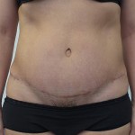 Tummy Tuck Before & After Patient #5082