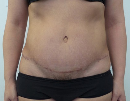 Tummy Tuck Before & After Patient #5082