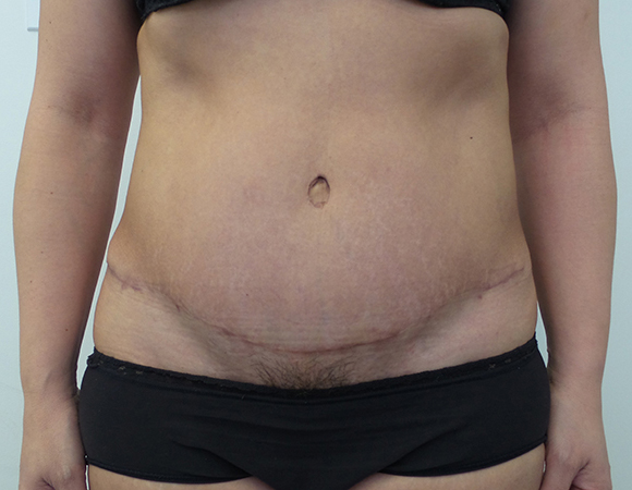 Tummy Tuck Before & After Patient #5082