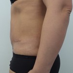 Tummy Tuck Before & After Patient #5082